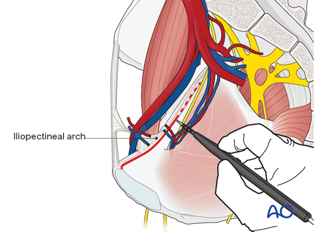 Periosteum dissection from superior pubic bone