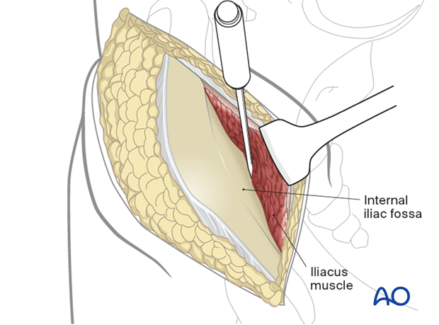 Deep dissection for ASIS osteotomy