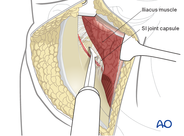 SI joint capsule identification