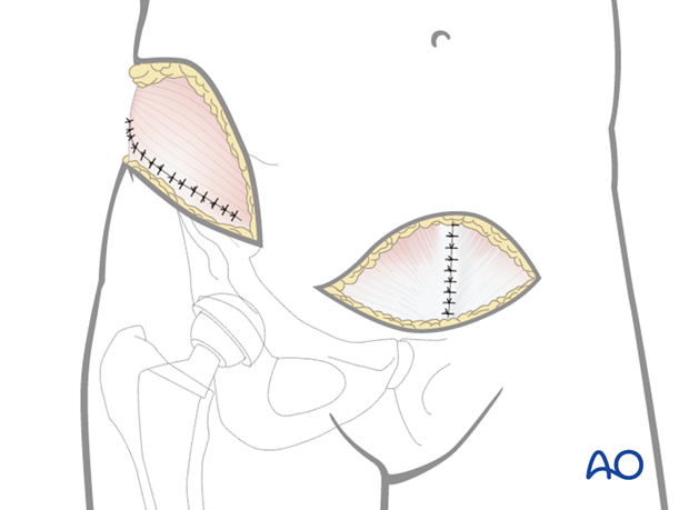 Wound closure in an anterior intrapelvic approach