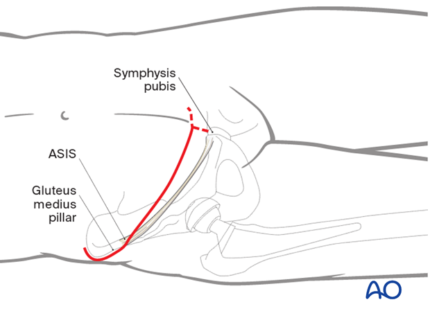 Skin incision for an ilioinguinal approach