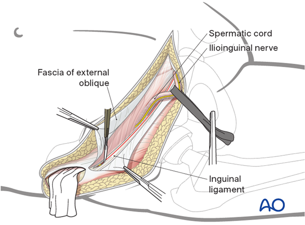 Release of the muscular attachment from the inguinal ligament