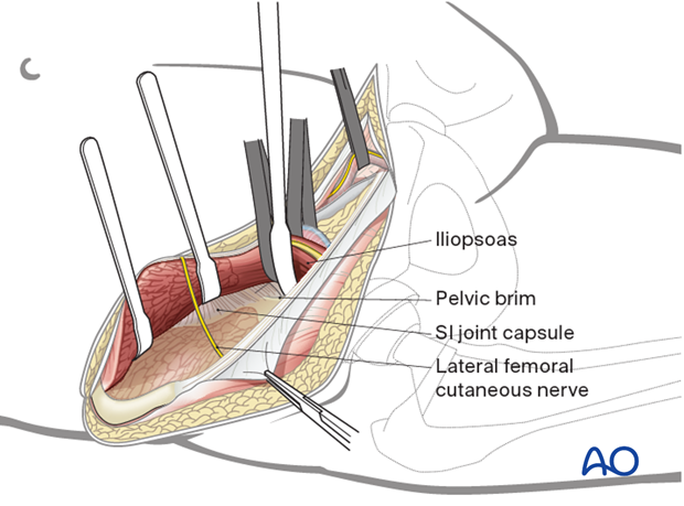 First window for ilioinguinal approach