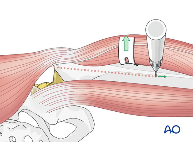 Osteotomy outline