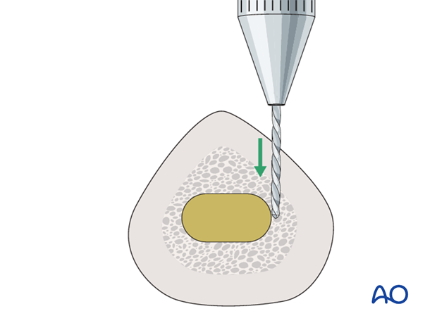 Disruption of the bone/prosthesis interface