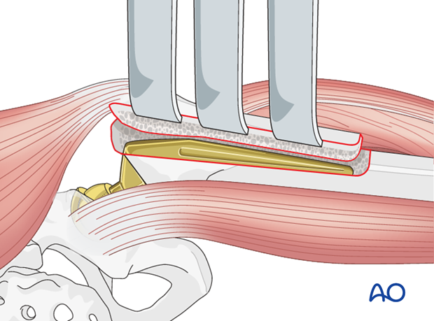 Extended Trochanteric Osteotomy retraction