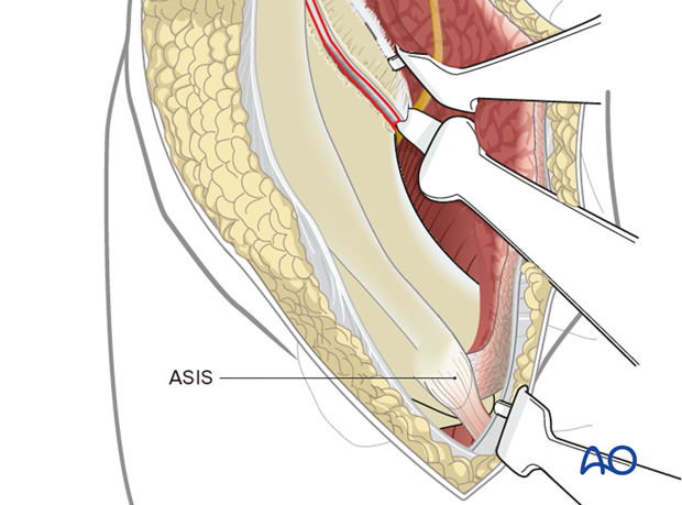 ASIS exposure