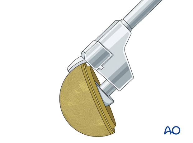 Acetabular osteotome system for cup removal with short blade