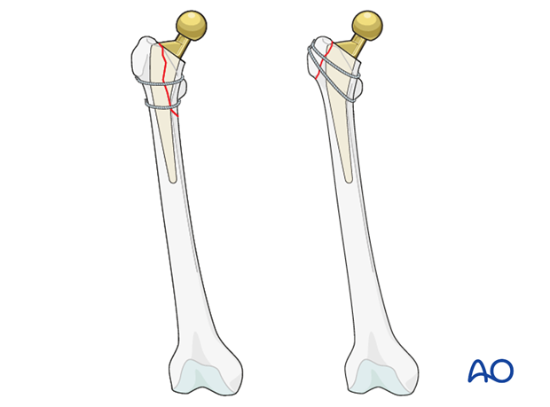 Isolated cerclage in a periprosthetic femoral fracture with a stable prosthesis