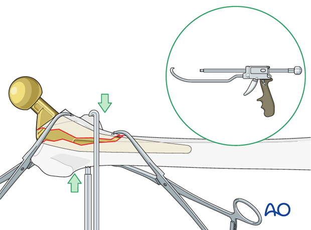 Direct reduction of the lesser trochanter