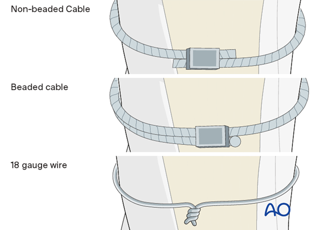 Implant selection