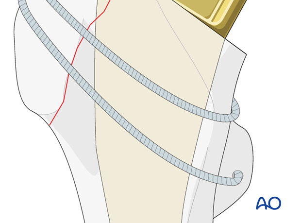 Hole drilling in the lesser trochanter