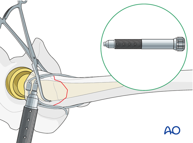 Wire tensioning for the greater trochanteric fractures