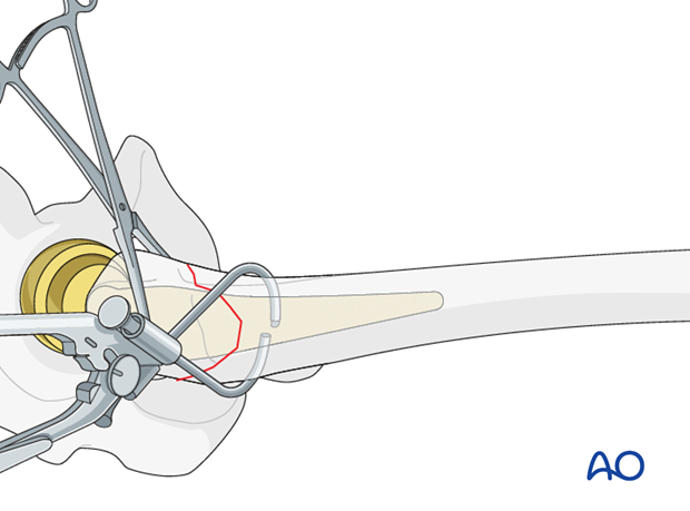 Male component insertion