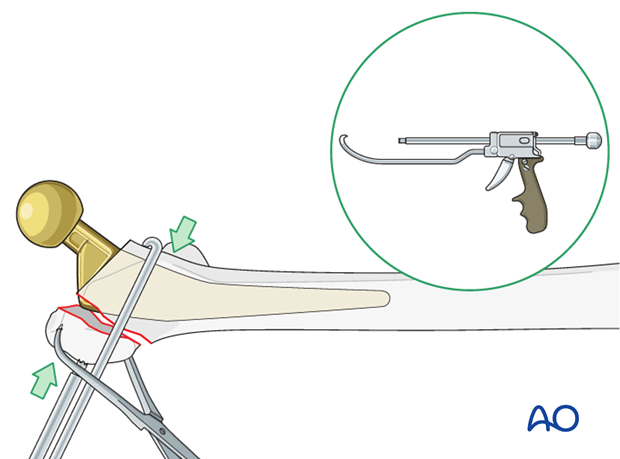 Direct reduction of the greater trochanter