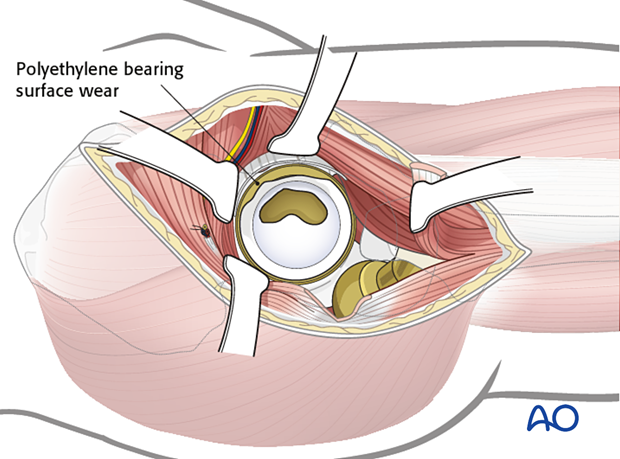 Polyethylene bearing surface wear