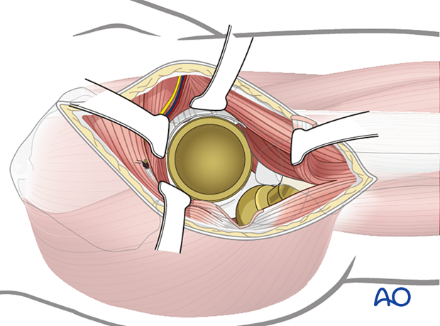 Acetabular exposure