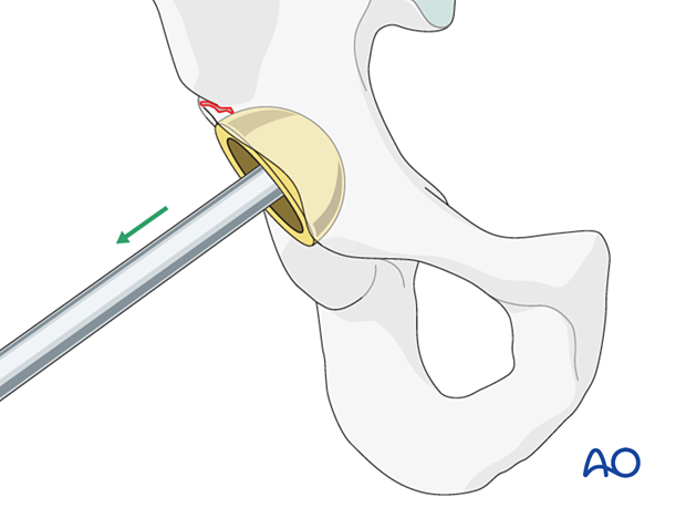 Removal of unstable cup