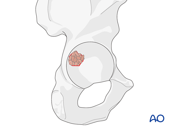 Bone graft