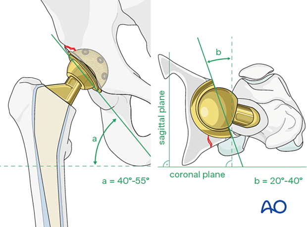 Safe zones for cup positioning