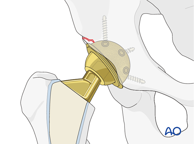 Multihole pressfit cup