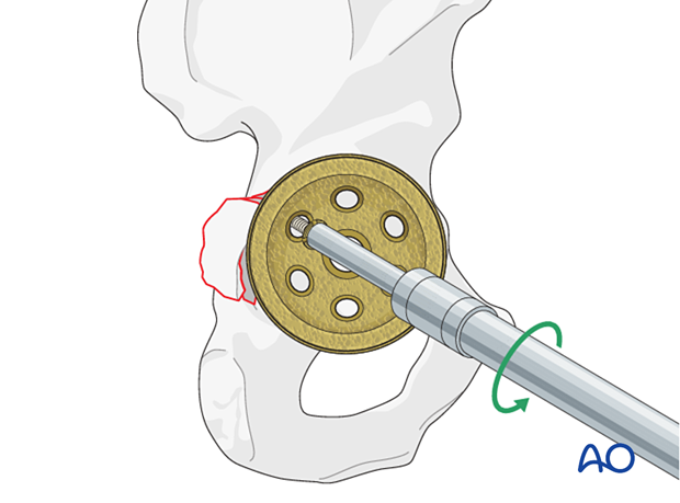 Cup screw removal