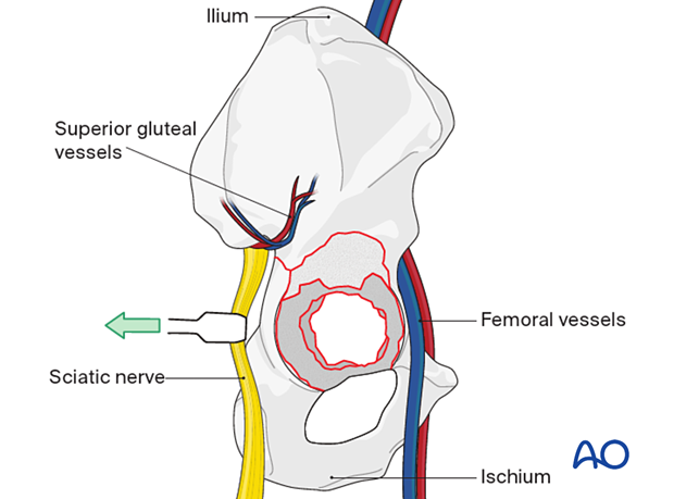 Fracture exposure