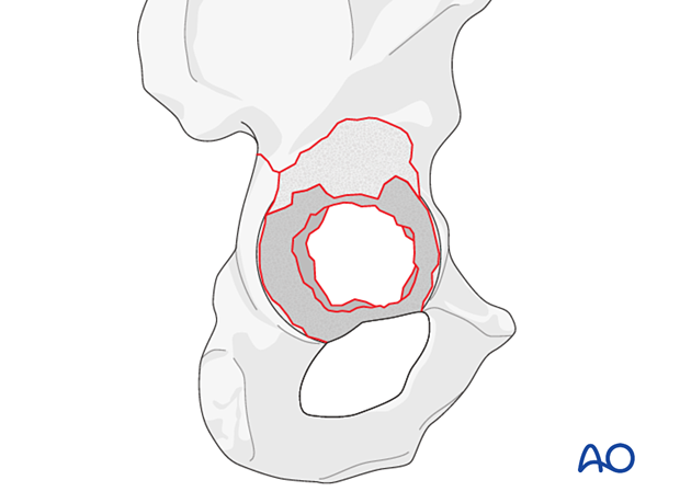 Major acetabular defect