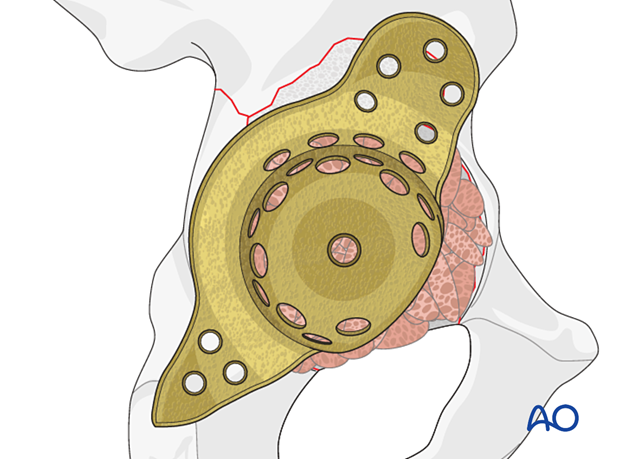 Antiprotrusio cage in combination with nonstructural bone graft