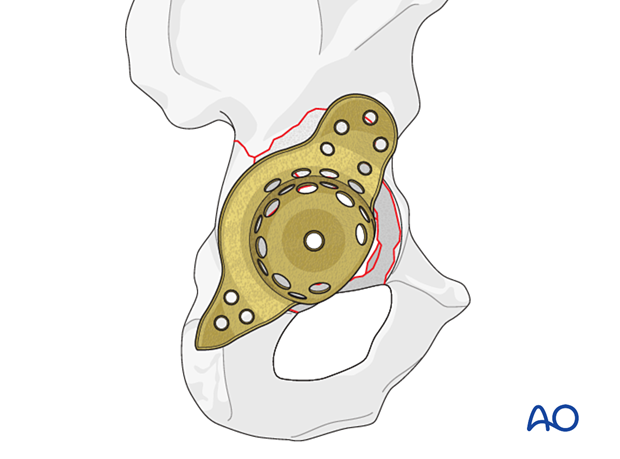 Implant sizing