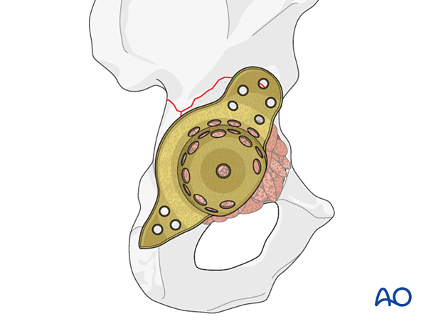 Bone graft insertion