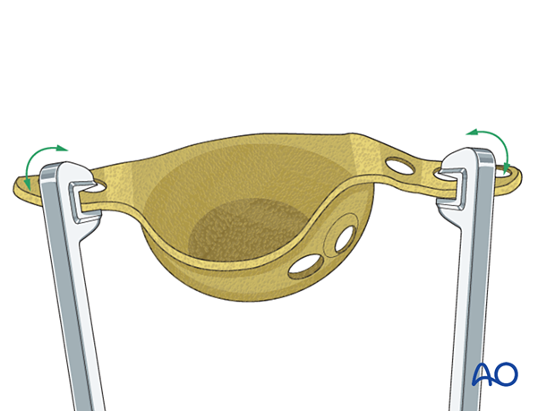 Implant contouring