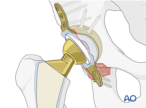 Cup revision to antiprotrusio cage