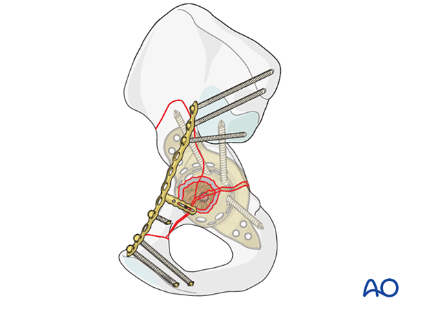 Acetabular protrusio repair