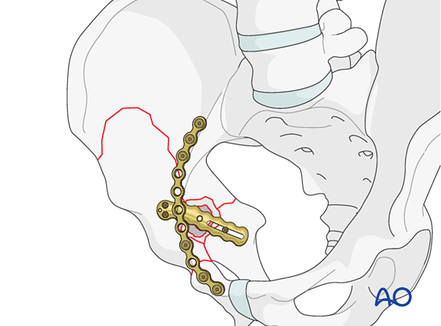 Protrusio preventing intraoperative cup stability