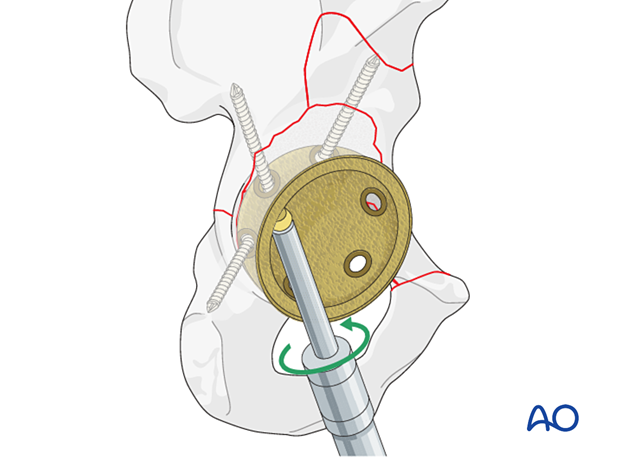 Cup screw removal