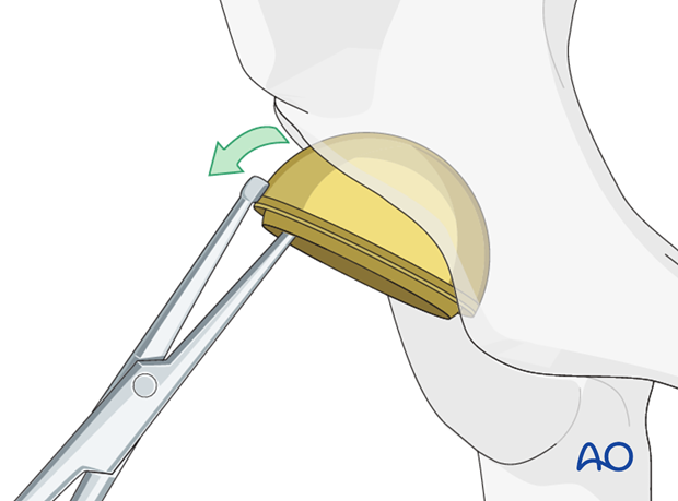 Acetabular component removal