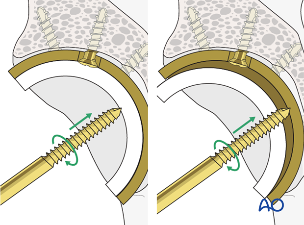 Polyethylene component removal from an acetabular cup