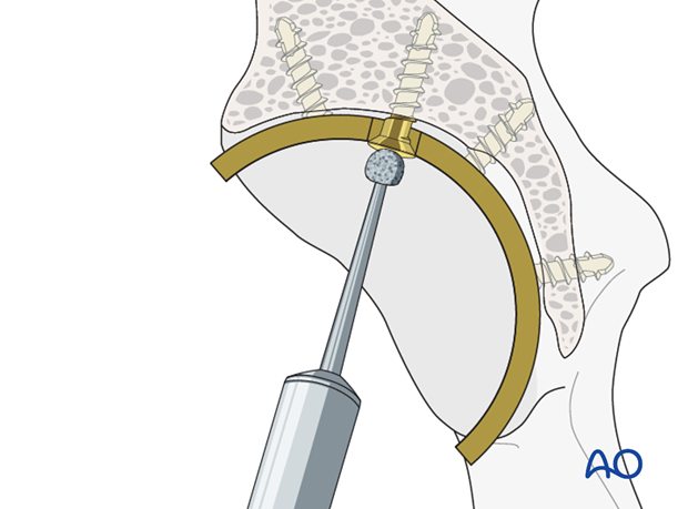 Screw head removal with a high-speed burr