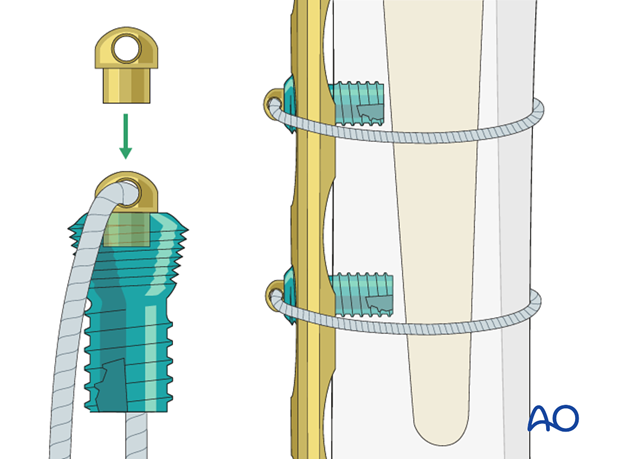 Cerclage buttons