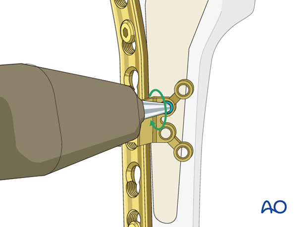 3.5 mm locking screw is inserted and screwed