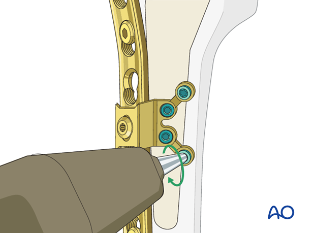 Additional locking screws