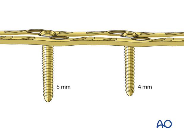 Screw diameter can also be variable within the same plate hole