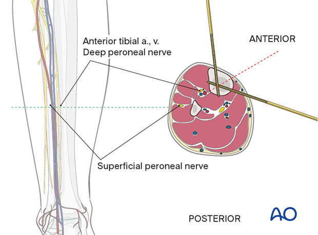 Tibial shaft