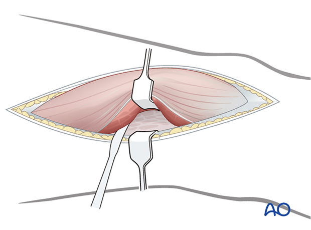 Elevation of vastus lateralis