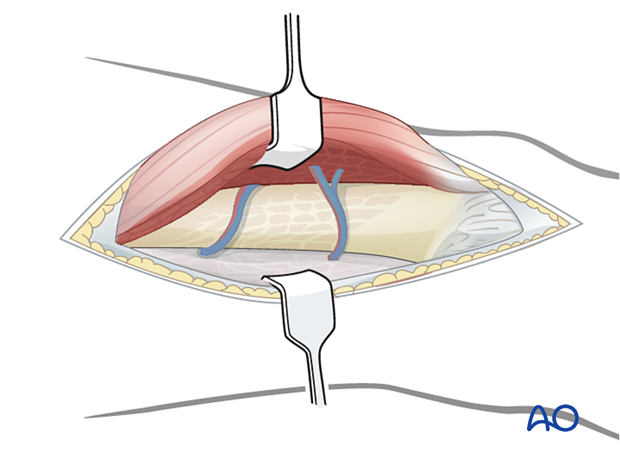 Retract the vastus lateralis anteromedially