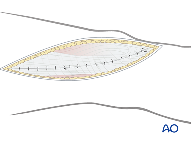 Wound closure