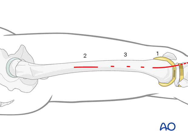 Minimally invasive plate osteosynthesis (MIO) approach to the distal femur from lateral/anterolateral