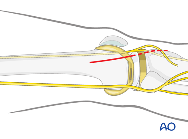 Distal approach