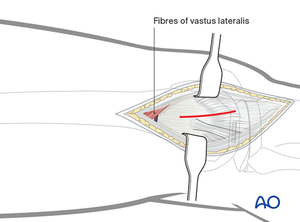 Joint capsule arthrotomy